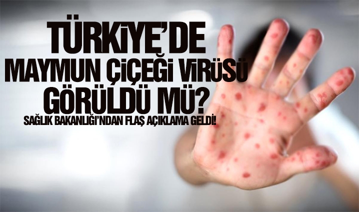 Türkiye’deki İlk “Maymun Çiçeği” Vakası